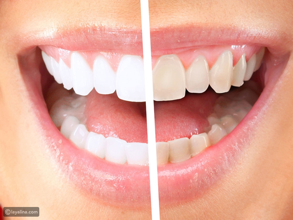 تبييض الأسنان بالليزر: كيفية تطبيقه وأثره على أسنانك
